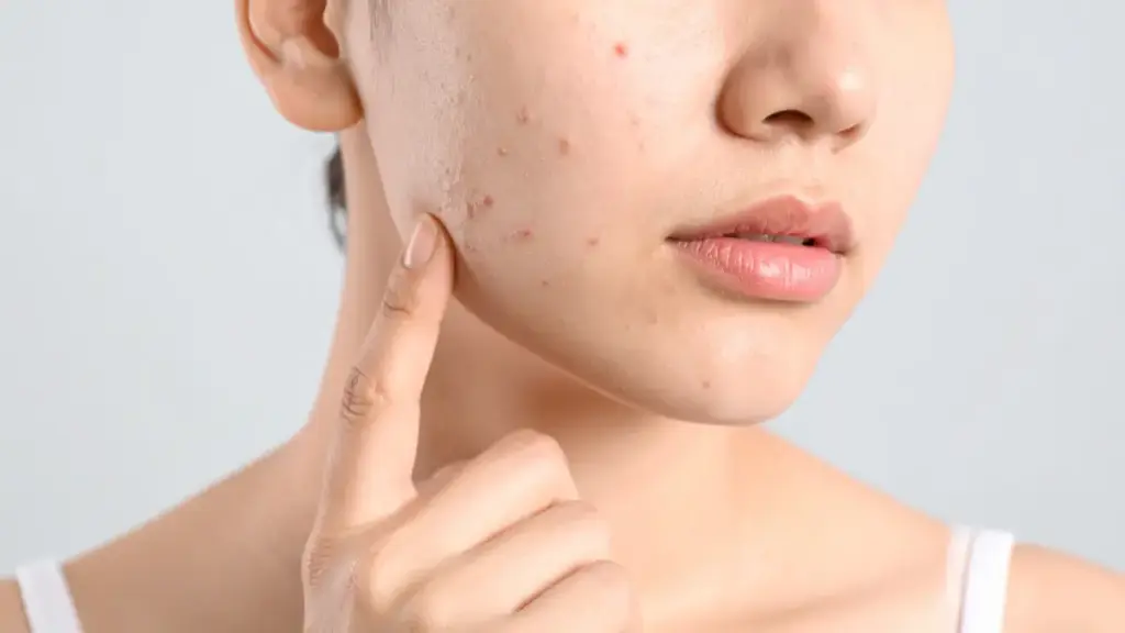 B ERL Very Berry Acne Spot Treatment, Senjata Praktis Lawan Jerawat Membandel