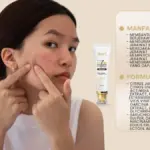 Jerawat Kecil Bisa Jadi Masalah Besar Kalau Salah Treatment: Ini Alasan Kenapa Acne Spot Treatment Lebih Aman