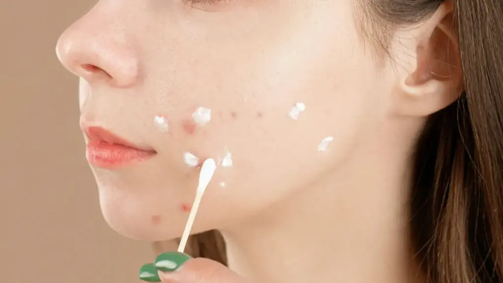 Kenali Jenis Jerawat dan Penanganannya