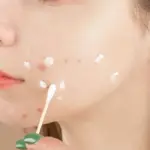 Kenali Jenis Jerawat dan Penanganannya